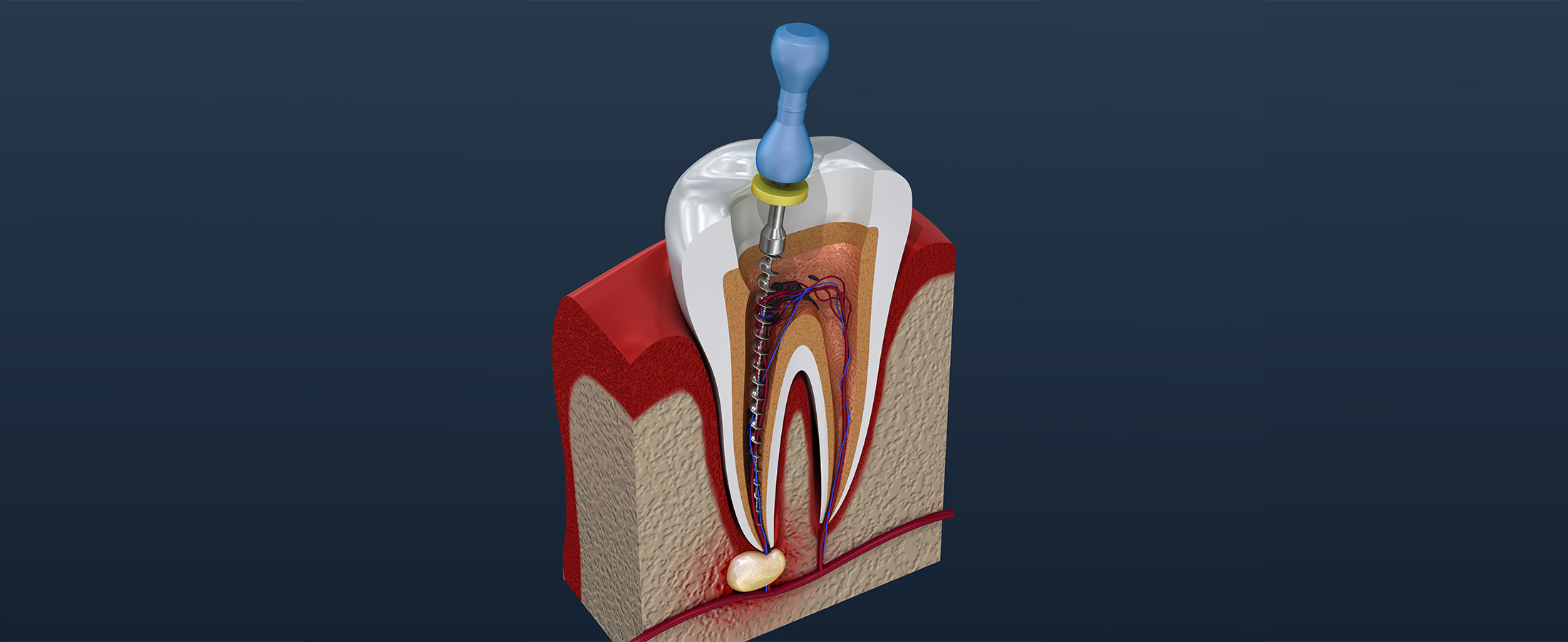 歯内療法（生活歯髄保存療法・根管治療）とは