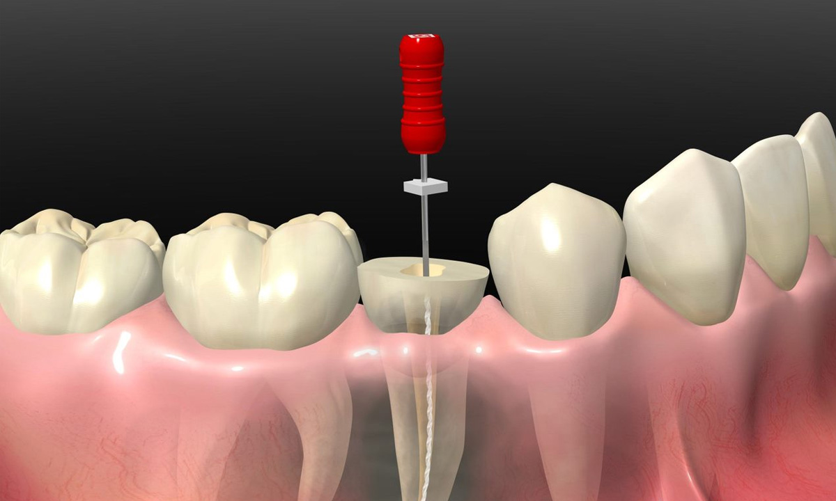 虫歯治療・歯内療法