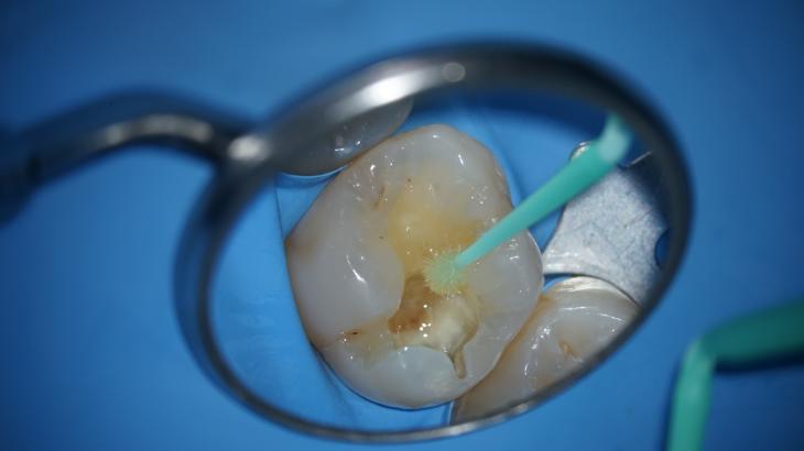 マイクロスコープを用いた虫歯治療で健康を取り戻す！？