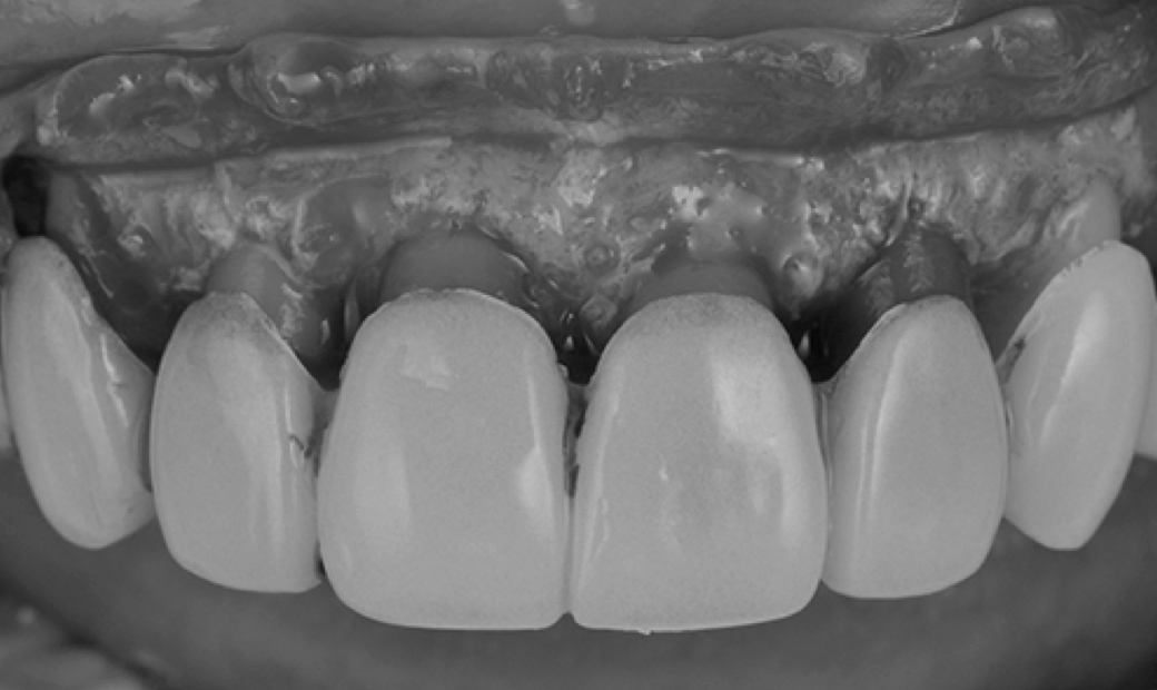5.歯周外科処置