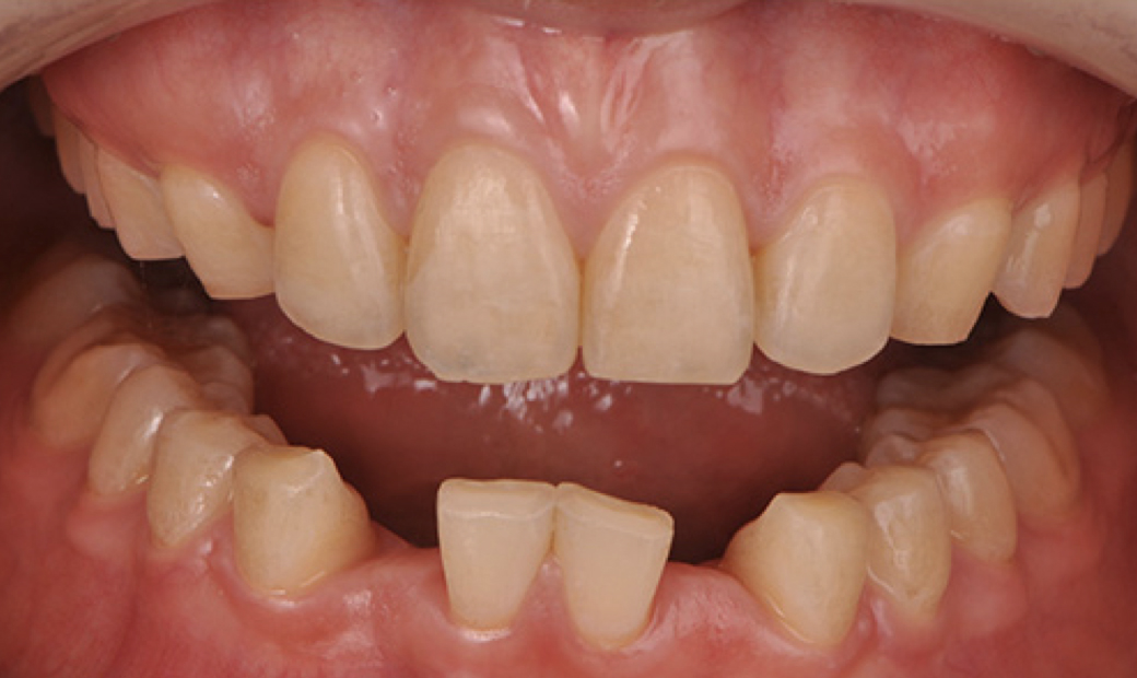 1.下顎前歯が先天性に欠損している