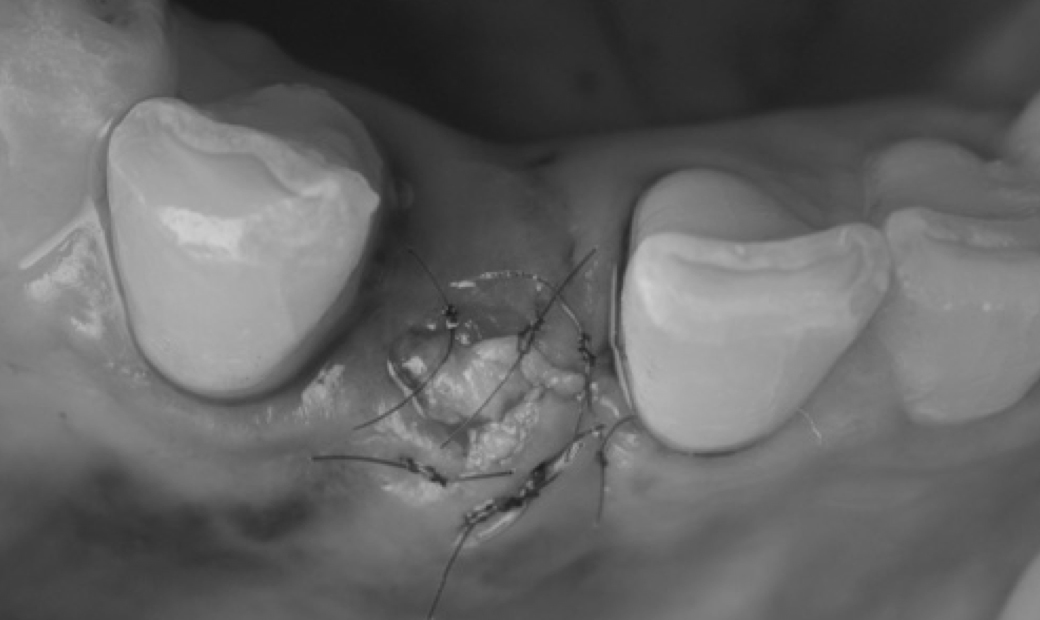 3.結合組織移植により歯肉の形を整える