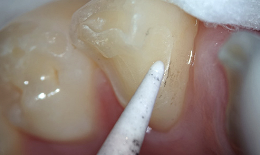 5.マイクロスコープ下にて歯牙形成