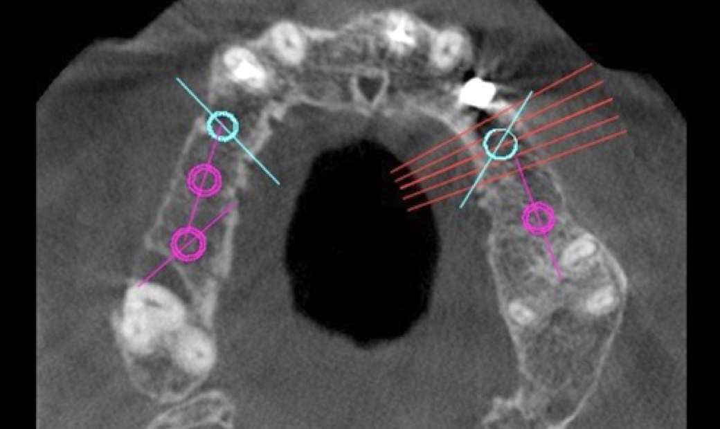 4.CTによるインプラント治療計画