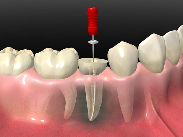 虫歯治療・歯内療法