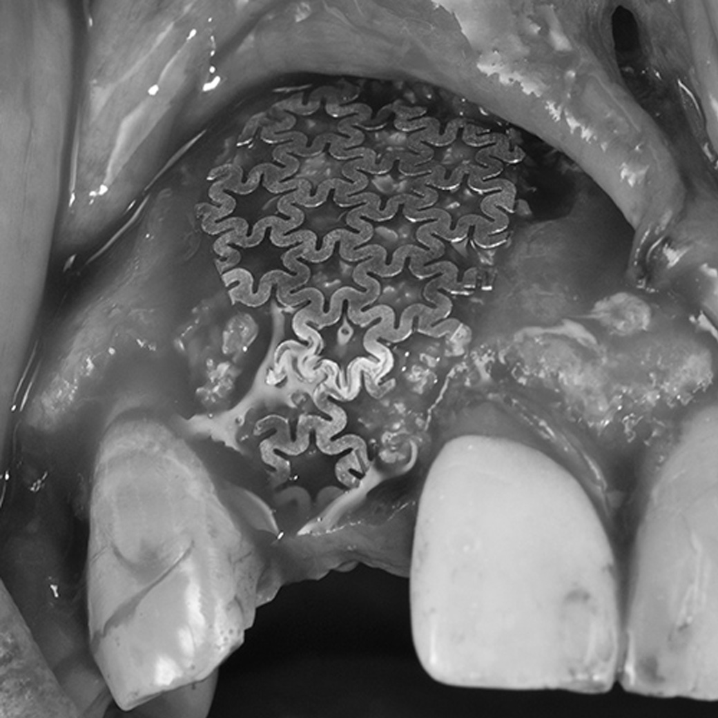 2.歯槽堤再生処置（骨移植）
