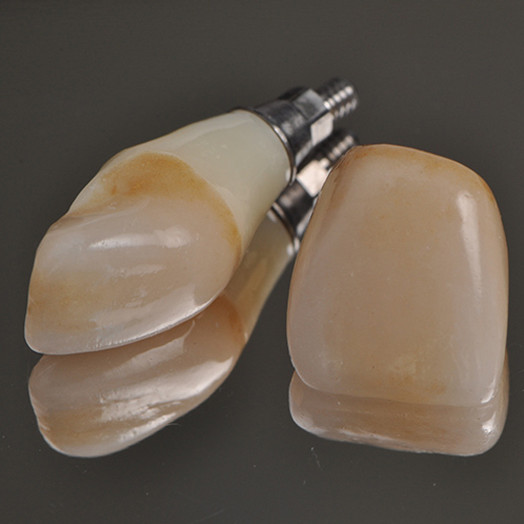 5.インプラント上部構造、天然歯部オールセラミッククラウンの完成