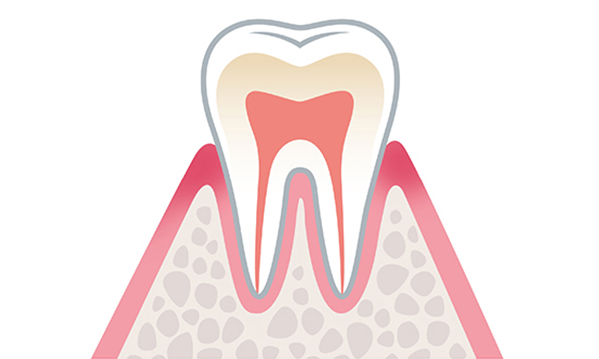 歯肉炎［歯周ポケット：2～3mm］