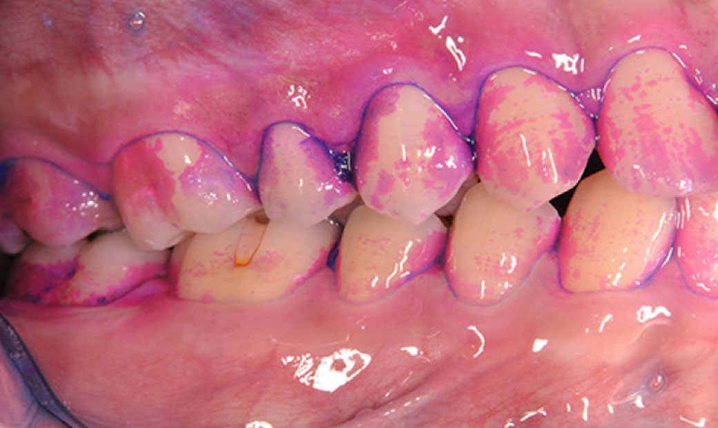 プラーク染め出しによる確認