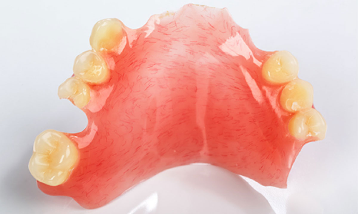 部分床義歯（部分入れ歯）
