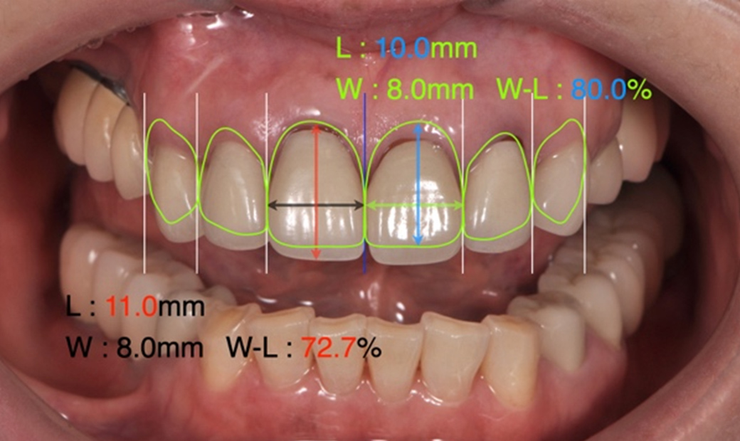 前歯6本の配列はゴールデンプロポーション（黄金比）を基準にし、歯の縦横比も理想的な数値を参考にデザインします